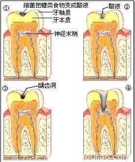 长蛀牙，真的是因为糖吃多了嘛？原来这才是真凶！