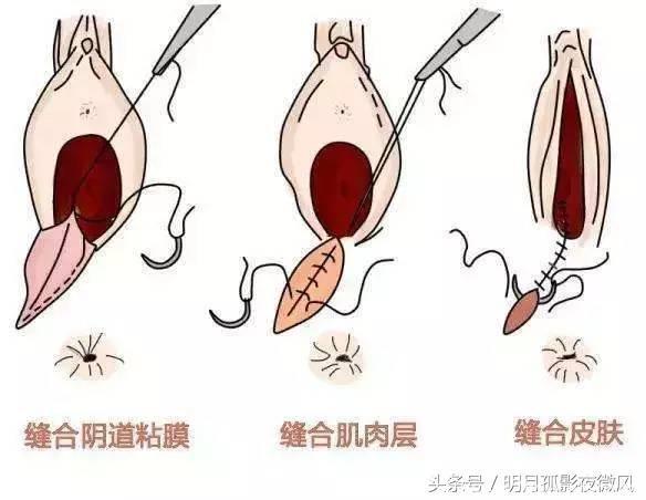 如果决定顺产 你不得不关注侧切的7个秘密