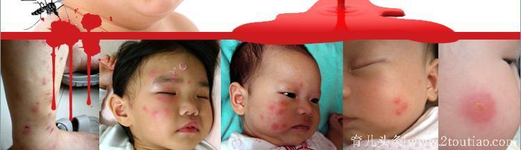 宝宝被蚊虫叮咬后，10种有效的止痒方法