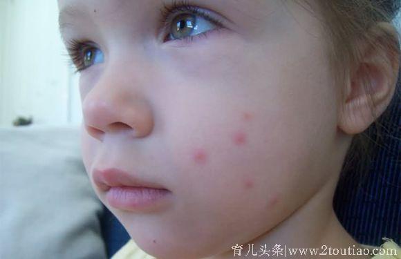 宝宝被蚊虫叮咬后，10种有效的止痒方法