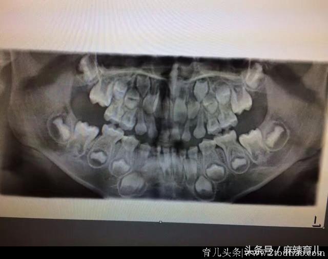 万万没想到！孩子坏牙的真凶原来是这个！