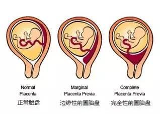 前置胎盘对孕妈妈和胎儿有风险吗？
