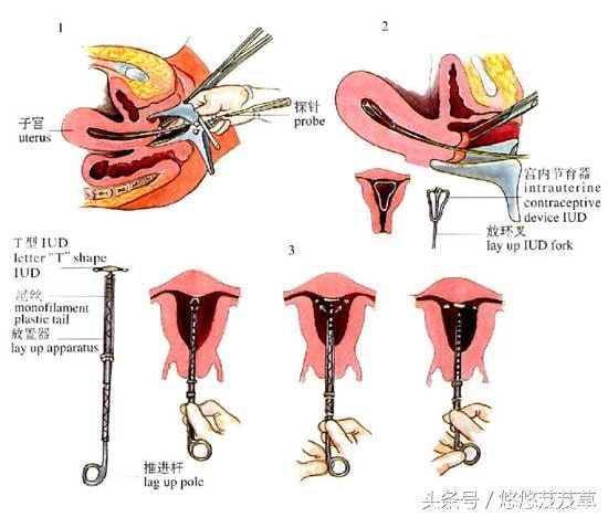 二胎剖腹产时，该不该连结扎手术顺便一起做