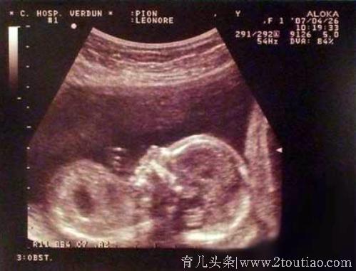 怀胎十月生下双胞胎，看到这对婴儿时，我却止不住的哭了！