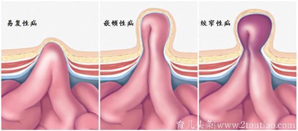 这种情况下千万别让宝宝哭！否则疝气就这样发生了！