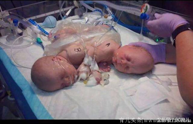 惊险！医院检查失误，孕妇差点错失双胞胎女儿！