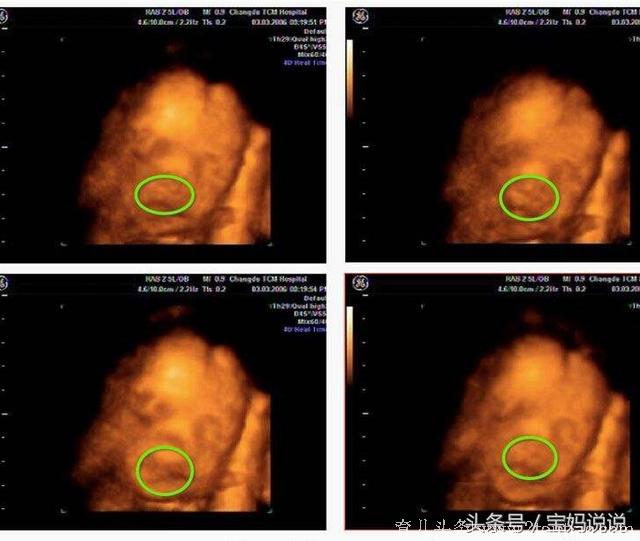 四维大排畸，“爱美”孕妈在看到四维彩超报告时，后悔大哭