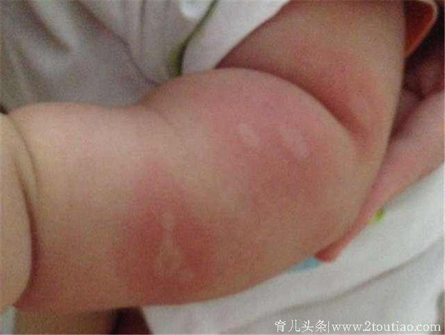 宝宝被蚊子咬了怎么止痒？又怎么防止被蚊子咬呢？