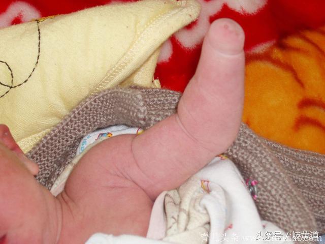宝宝出生后没左手，十几次产检为啥没发现