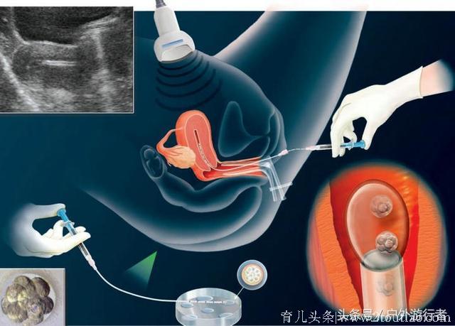 一位大龄宝妈讲述试管全过程，中间困难重重