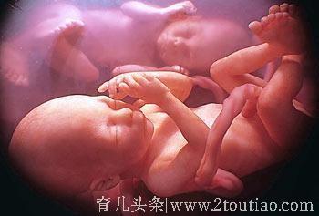 怀上双胞胎并发双胎输血综合征，俩宝都有影响，满心欣喜变忧愁