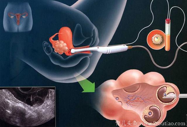 做试管婴儿全过程，看着都痛，真的心疼女人一万遍