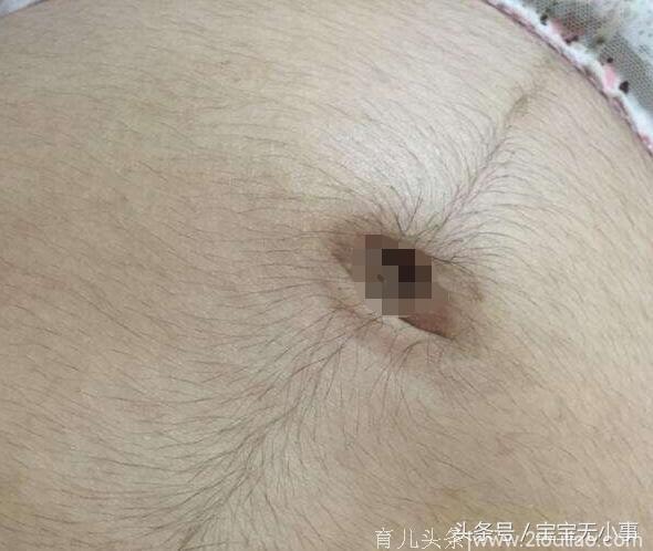 孕后肚子长了毛毛，婆婆知道后高兴坏了，说怀的是男孩