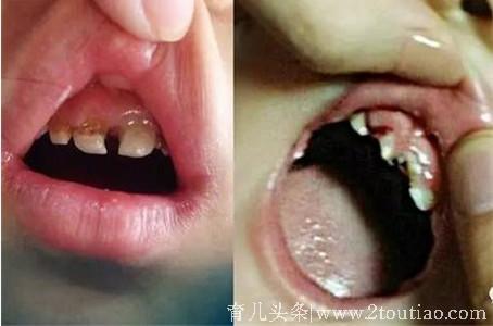 7岁男童牙齿烂光，警惕别让自己的懒惰毁了孩子一生
