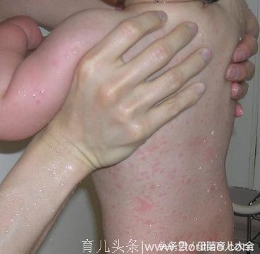 儿科医生：“高烧40℃的幼儿急疹，不用吃药可痊愈！”
