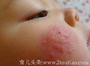 婴儿湿疹用什么药膏比较好比较安全？