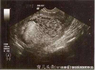 辛苦养胎发现竟是假怀孕！这可怕的葡萄胎到底是何怪物？太惊悚！