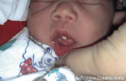产妇分娩胎儿吓坏医生，在他嘴里竟发现此物，仅有1‰的概率发生