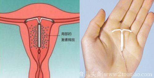 节育器到期，去医院取环会疼吗？还有什么需要注意的？