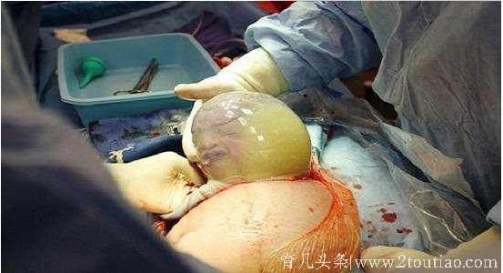 带羊膜囊出生的神奇宝宝，剪破羊膜囊的瞬间，感动得让人泪目