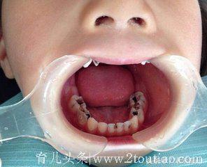 三岁孩子从不吃糖却满嘴烂牙，父母到诊所补牙才发现自己无知