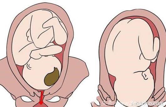 临产胎儿缺氧致死，怀孕后上厕所“这个习惯”别再做了！
