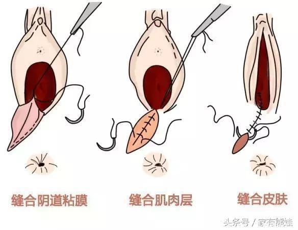 侧切和剖腹产到底哪个更疼？两种疼都经历过的我来告诉你……