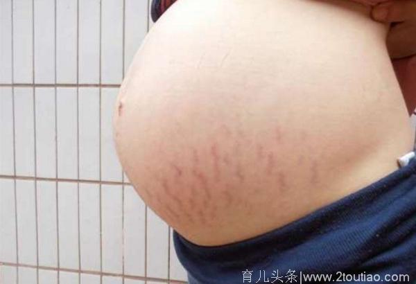 32岁妈妈生完二胎后，肚皮变成这样，老公都吓坏了