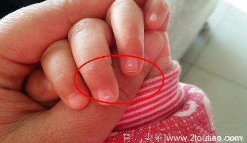 孩子手指长倒刺、指甲有白点，到底因为缺什么？