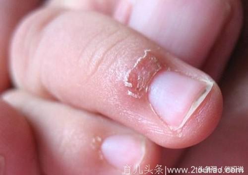 孩子手指长倒刺、指甲有白点，到底因为缺什么？