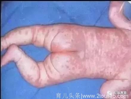 如何区分湿疹、急疹、痱子、荨麻疹、水痘、婴儿痤疮、过敏？