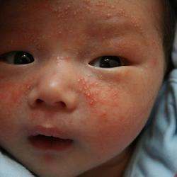 遇到婴儿湿疹，该怎么办？