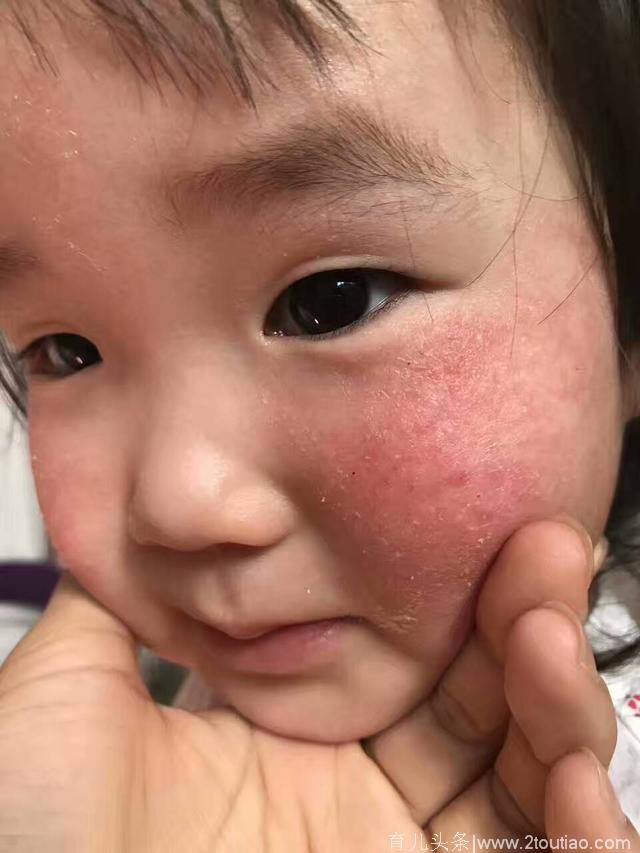 遇到婴儿湿疹，该怎么办？