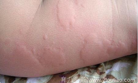 湿疹，痱子，急疹，荨麻疹，婴儿痤疮如何简单区分？该怎么治疗？