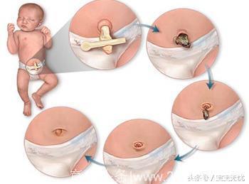 小肚脐，新生儿宝宝重点保护区，如何处理脐带和注意事项