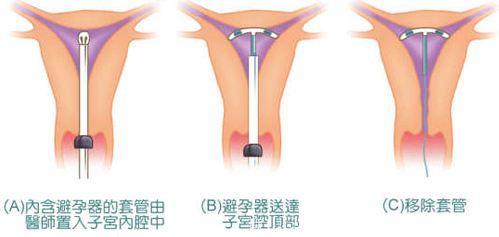 上环为避孕，你可知上环相当于每月刮宫，看完你还要上？