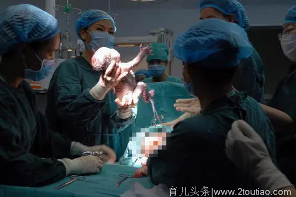 3胞胎产妇分娩 抱出第3个后 又有意外发现！