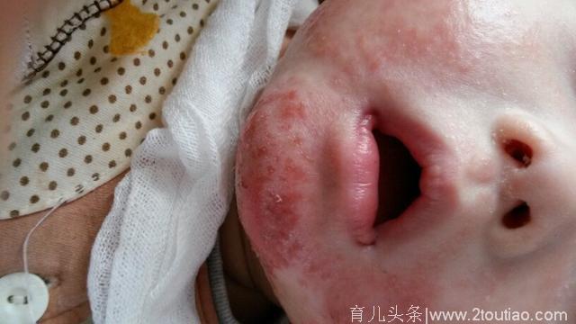 宝宝湿疹反复，育婴师支了一招，3天彻底痊愈了！