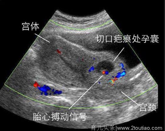 怀孕五个月的孕妇被迫引产，只因小两口在孕期做了这件蠢事