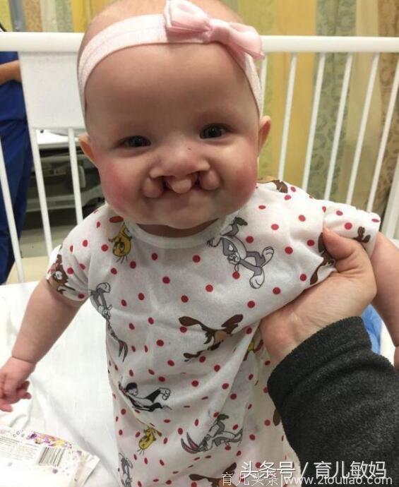“兔唇”宝宝成功完成手术治疗，拆线那一刻，妈妈既开心又心酸