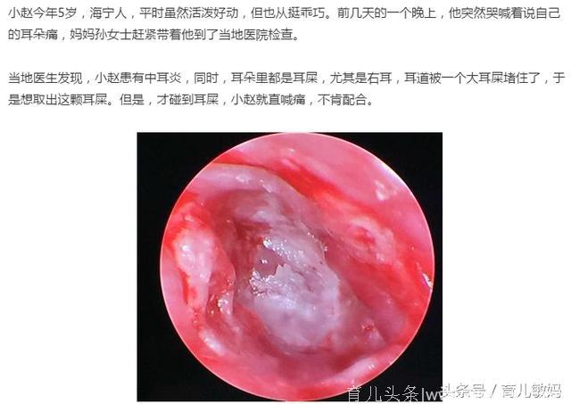 5岁男孩掏颗耳屎花了5000元 妈妈不勤奋一点都不行啊