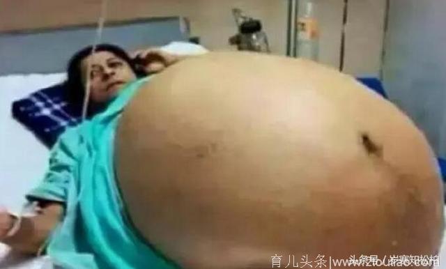 女孩怀孕肚子大的出奇，十几个医生为她接生：生了一个足球队！