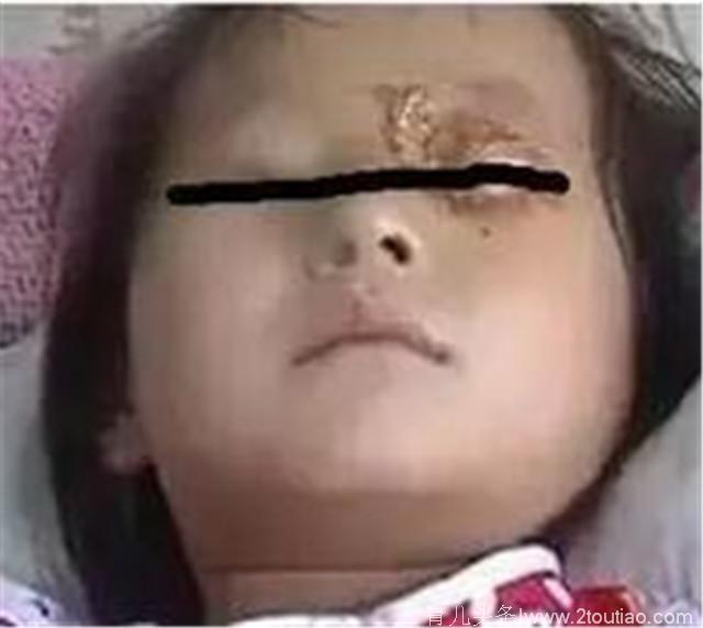 女孩过生日导致眼睛终生受损，背后的原因值得所有父母警惕