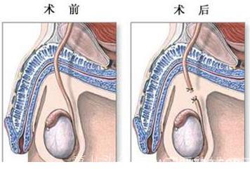 不想再生了，避孕的话，你选择男结扎还是女上环？