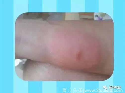 宝宝被蚊虫叮咬后，抹什么能快速止痒？