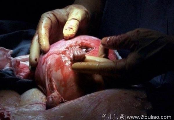 被弃婴儿突然从子宫伸出手拉住医生 生命的伟大让人惊叹