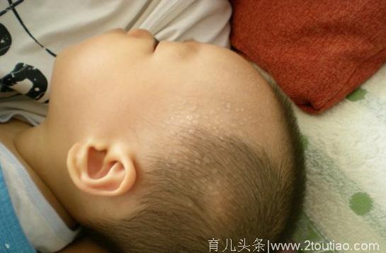 宝宝一睡着就满头大汗，这是生病了还是正常的？还是缺少什么导致的
