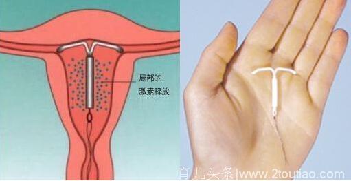 上环相当于每个月刮宫1次，到底要不要上环