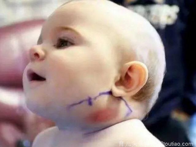9个月宝宝脖子长出毛状物体 拔出来一看 医生都傻眼！