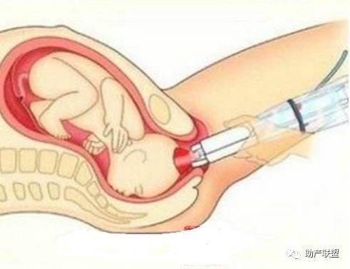 五种分娩术助产妇安全分娩